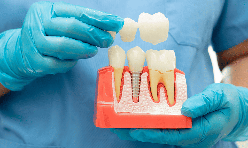 Crowns, Bridges & Dentures