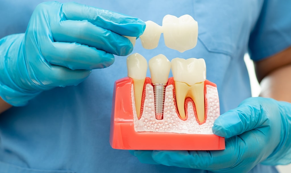 Crowns, Bridges & Dentures