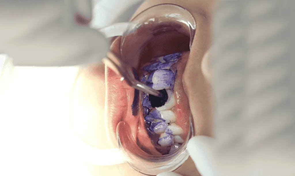 Guided Biofilm Therapy (GBT) Jibla Dental Center