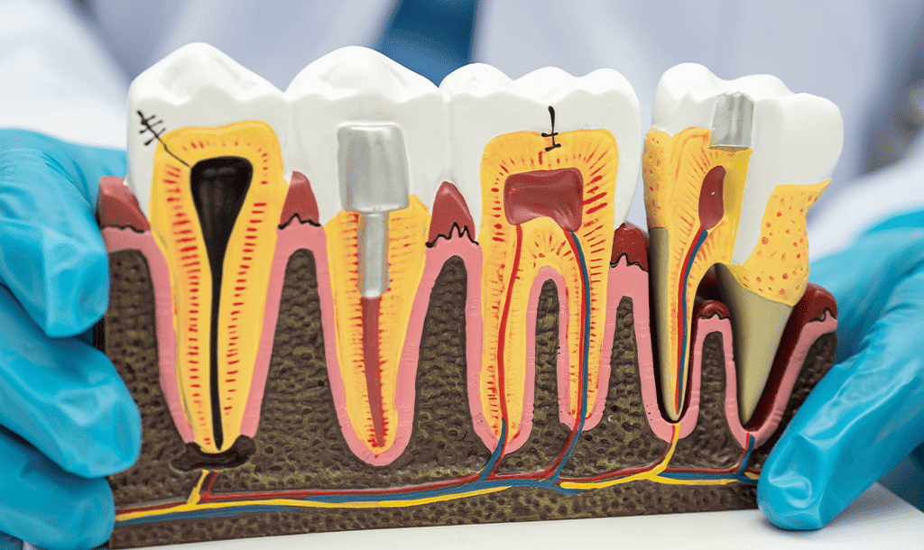 Jibla Dental Center - root Canal