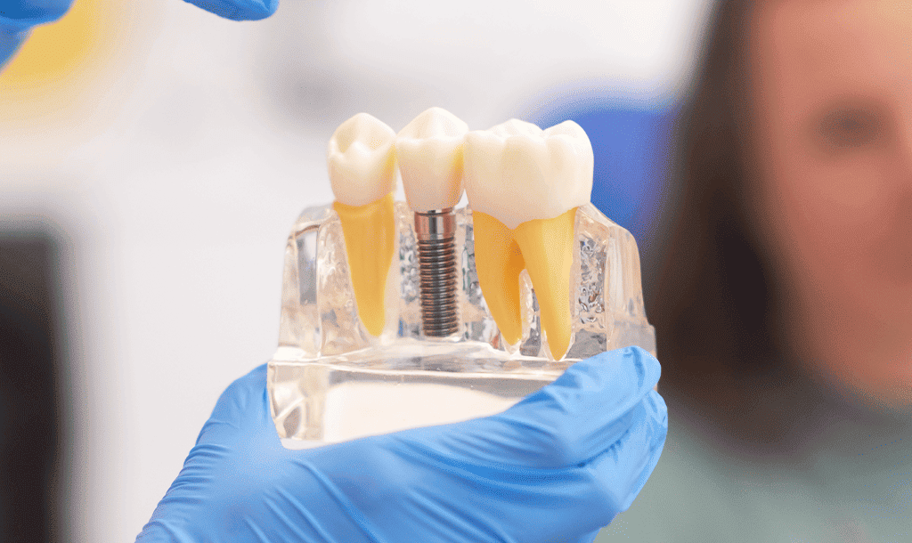 Jibla Dental Center - Dental Implants